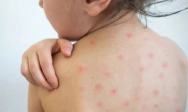 Ermənistanda qızılca epidemiyası hökm sürür