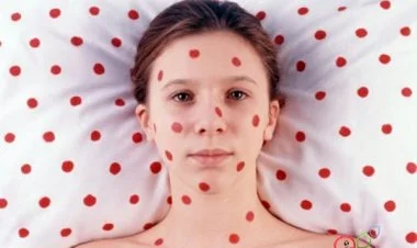 Avropada qızılcaya yoluxma halları kəskin artır