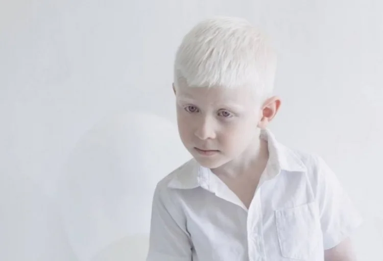 Beynəlxalq Albinizm haqqında Maarifləndirmə Günüdür