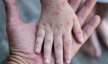 TƏBİB qızılcadan öldüyü deyilən şagirdlə bağlı məlumat yaydı