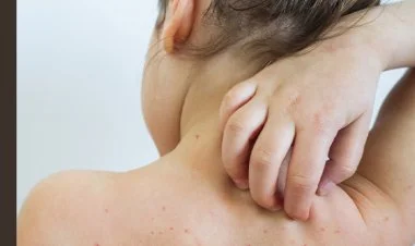 Zaqatalada qızılca xəstəliyi yayılıb