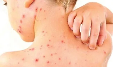 Məktəb və universitetlərdə qızılca xəstəliyi yayılır