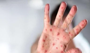 Azərbaycanda 284 nəfər qızılcaya yoluxub