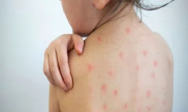 Sığınacaqda qızılcaya yoluxan uşaqlardan 10-u xəstəxanadadır