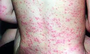 Şəmkirdə qızılcadan ölən uşaqla bağlı rəsmi məlumat