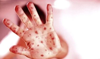 ABŞ-ın 12 ştatına qızılca epidemiyası yayılıb