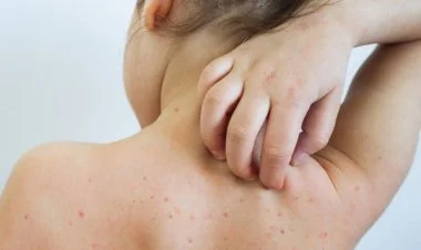 Azərbaycanda qızılcaya yoluxma get-gedə azalır