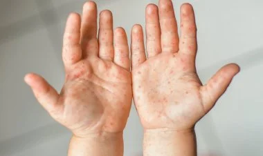 Azərbaycanda uşaqlar arasında Koksaki virusu yayılıb