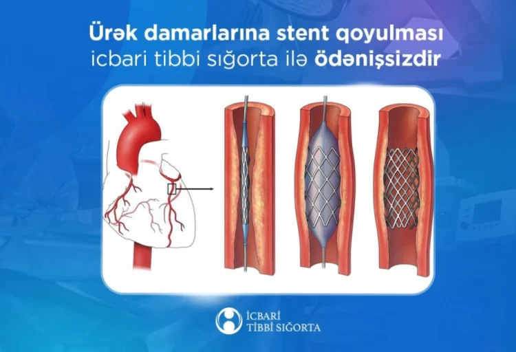 Ürək damarlarına stent qoyulması ödənişsizdir