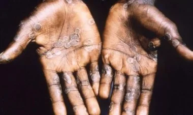 Afrikada meymunçiçəyi virusu sürətlə yayılır