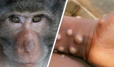 Türkiyədə meymunçiçəyinə yoluxma şübhəsi