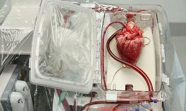 Qafqazda ilk dəfə Azərbaycanda meyit donorun ürəyi köçürülüb